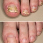 Nail Infection: Causes, Symptoms & Complete Treatment Guide (2026)