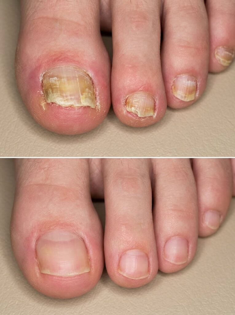 Nail Infection: Causes, Symptoms & Complete Treatment Guide (2026)