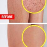 🍓 Strawberry Legs: Causes, Treatment & Smooth Skin Guide