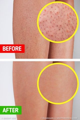 🍓 Strawberry Legs: Causes, Treatment & Smooth Skin Guide